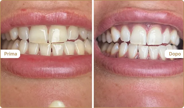 Before and After