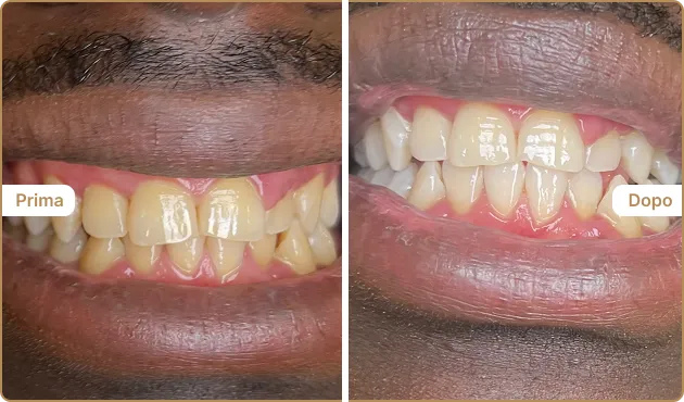 Before and After
