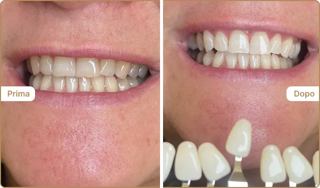 Before and After