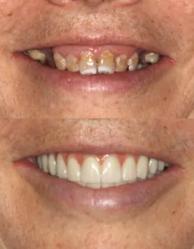 Smile Makeovers