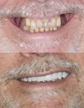Snap on Dentures