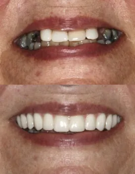 Permanent Implants
