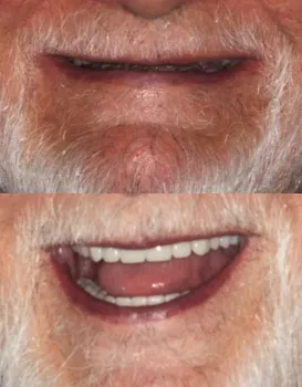 Smile Makeovers