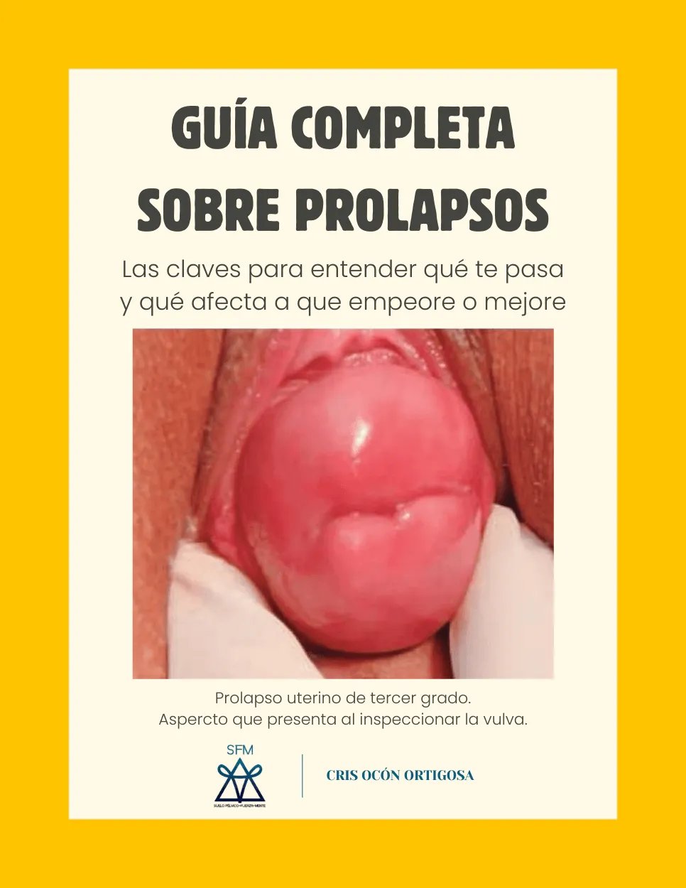 Guía gratuita prolapsos
