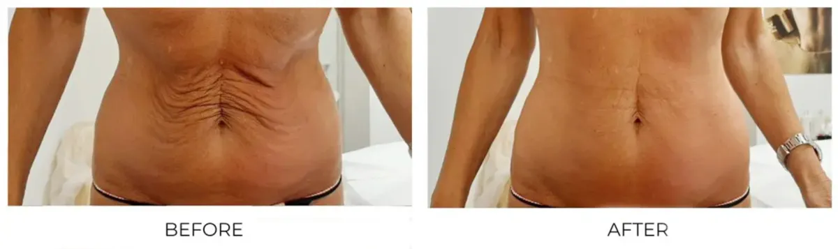 Stomach Before and After