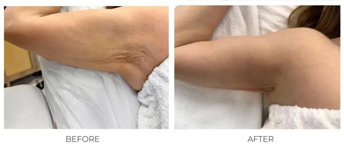 Arm Before and After