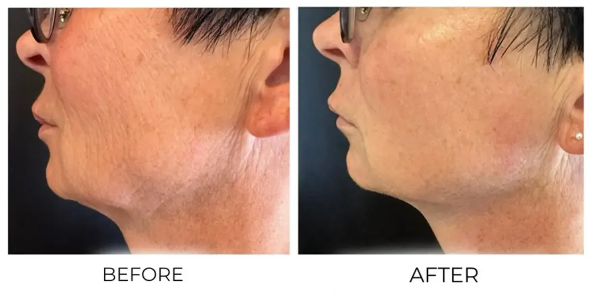 Face Before and After