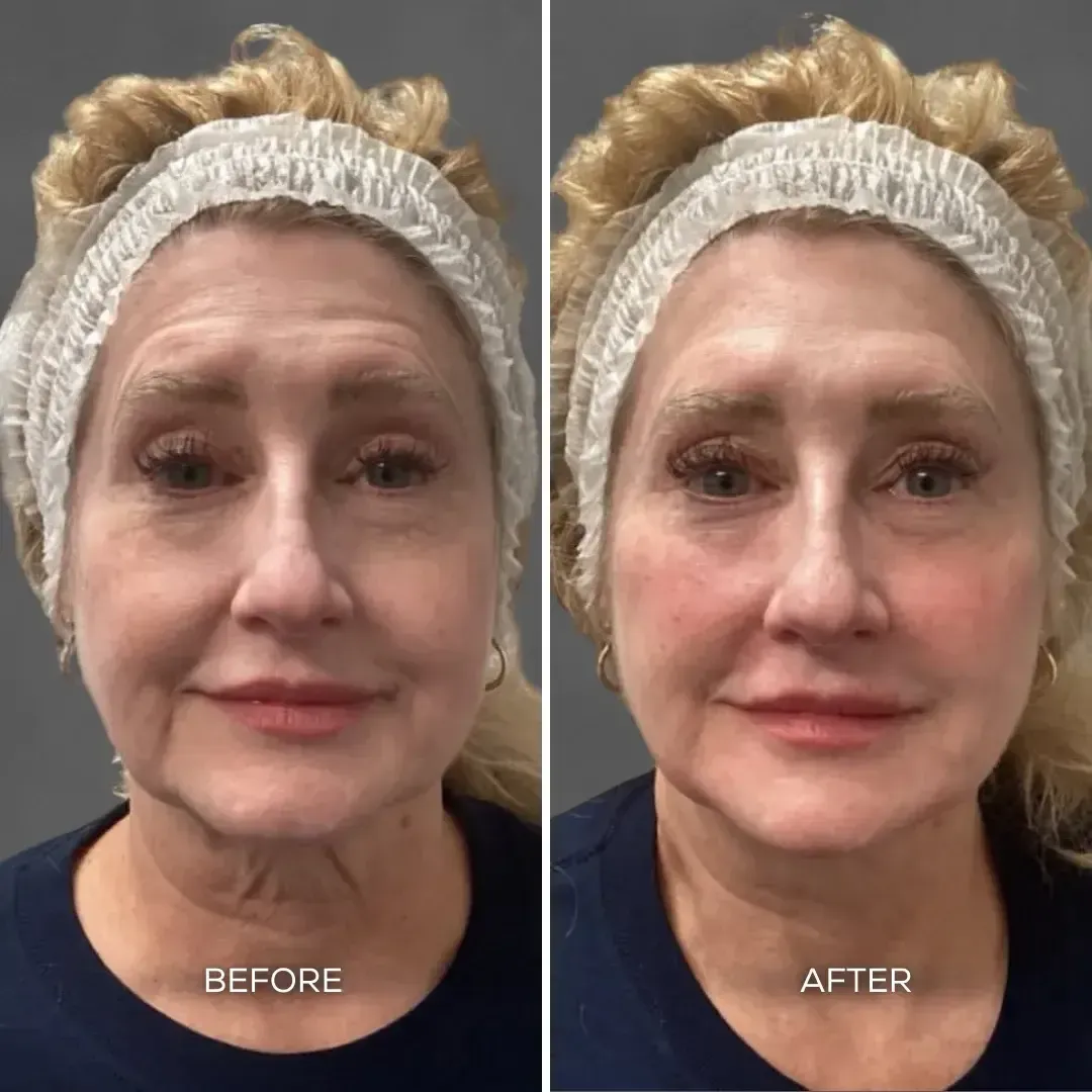 Before and after full face balancing treatment showing improved facial contour and volume at Chrome Aesthetics Spa