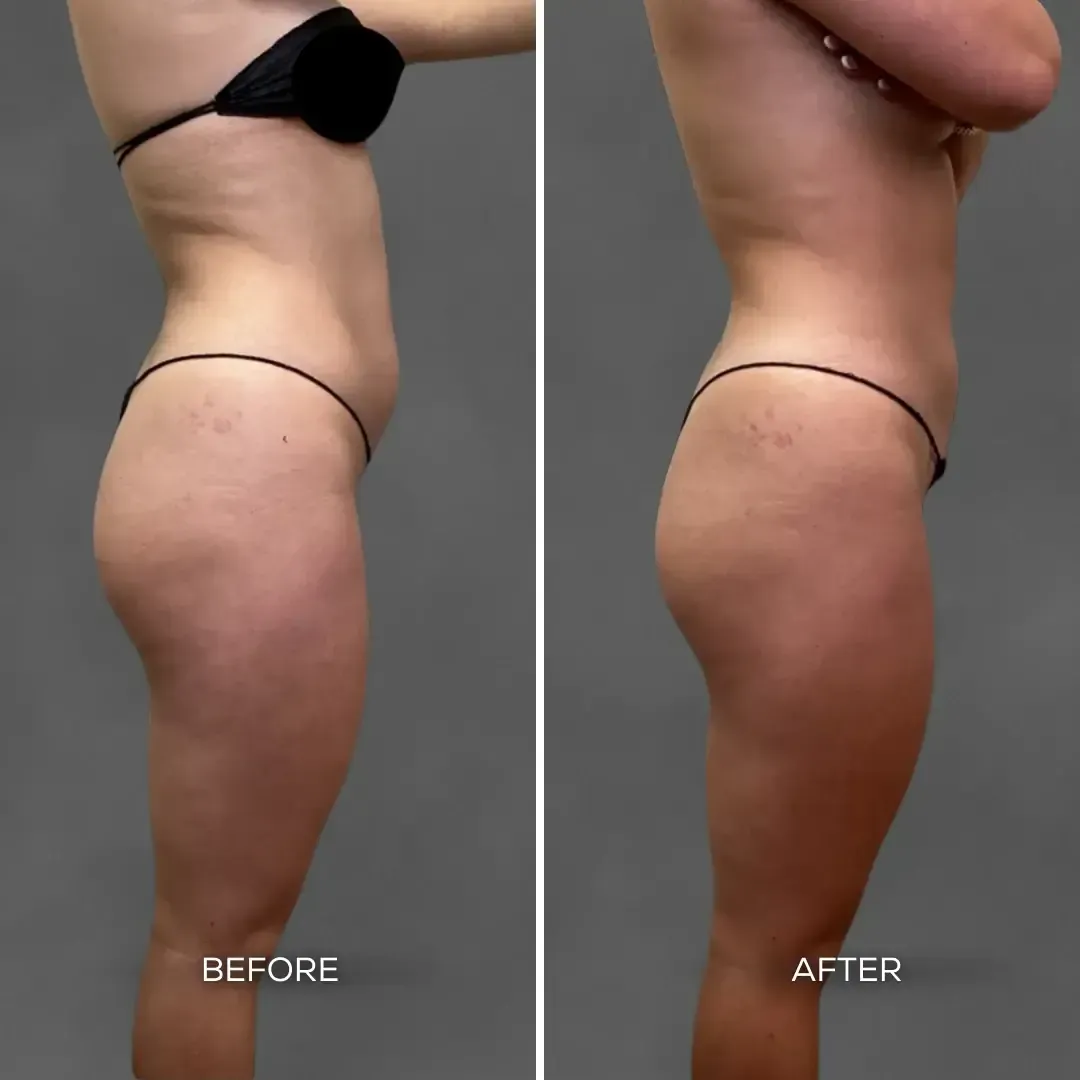"Before and after BodyTite treatment showing tightened waist and contoured silhouette at Chrome Aesthetics Spa