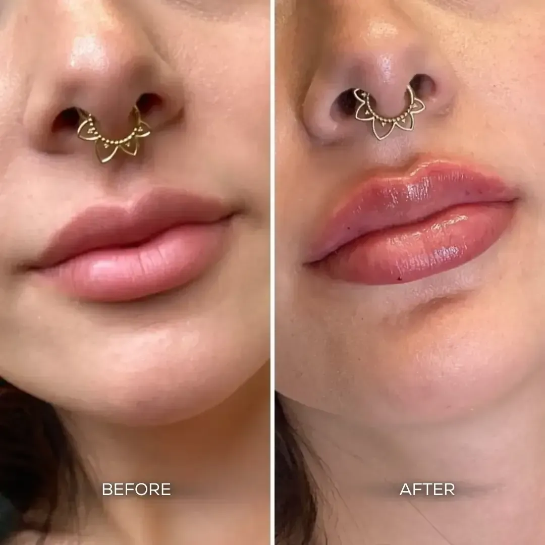 Before and after lip filler injections showing fuller, more defined lips at Chrome Aesthetics Spa