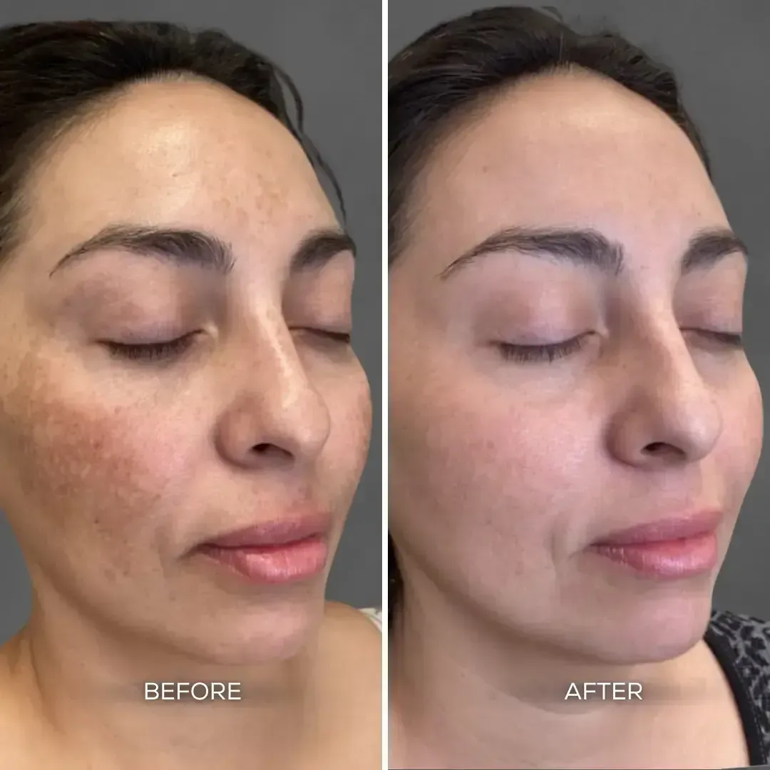 "Before and after laser treatment showing reduced pigmentation and melasma on face at Chrome Aesthetics Spa