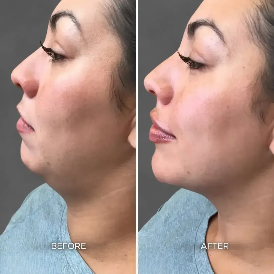 Before and after chin and jawline filler showing improved facial contour and definition at Chrome Aesthetics Spa