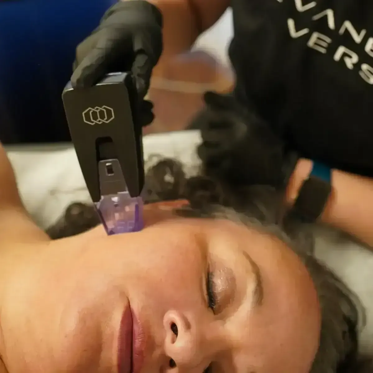 A woman getting a laser treatment in Chrome Aesthetics