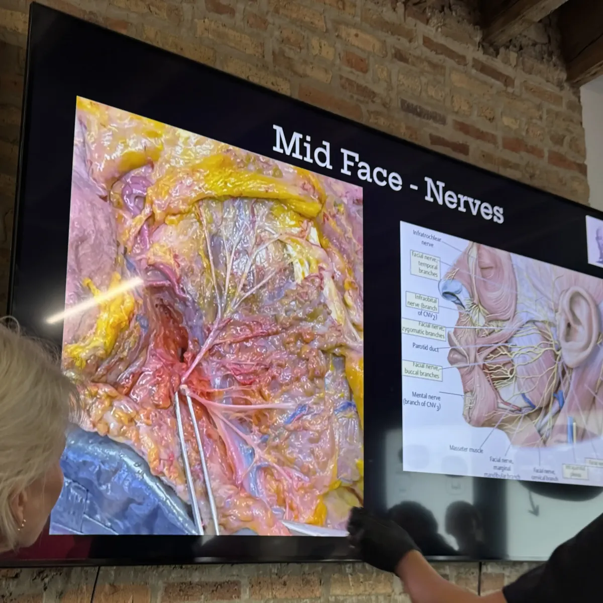 Anatomy teaching slide on a large screen displaying mid-face nerves and muscles during a professional aesthetic training session at Chrome Aesthetics Academy.