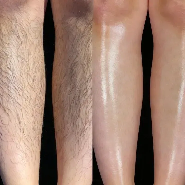 Smooth legs following professional laser hair removal session.