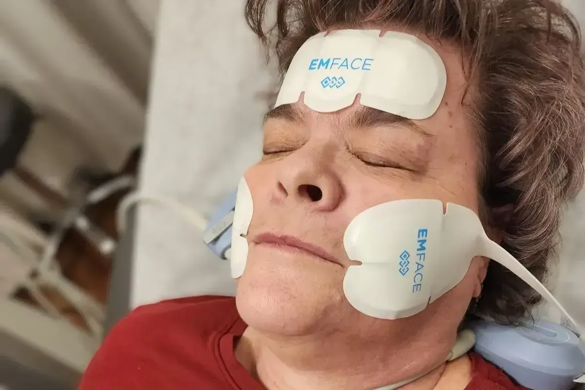 Patient relaxes with eyes closed during Emface treatment with applicators placed on her forehead and cheeks.