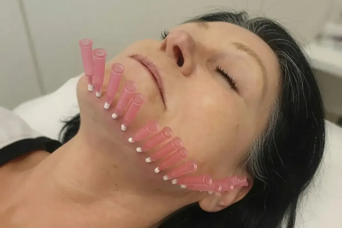 Woman lying with eyes closed during a PDO Thread Lift procedure, with multiple pink PDO threads placed along her jawline and lower face for skin tightening and lifting.