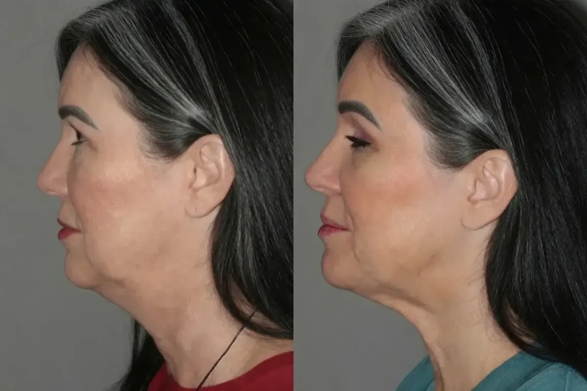 Side profile before and after photos of a woman demonstrating a more defined jawline and improved lower facial contour after treatment.