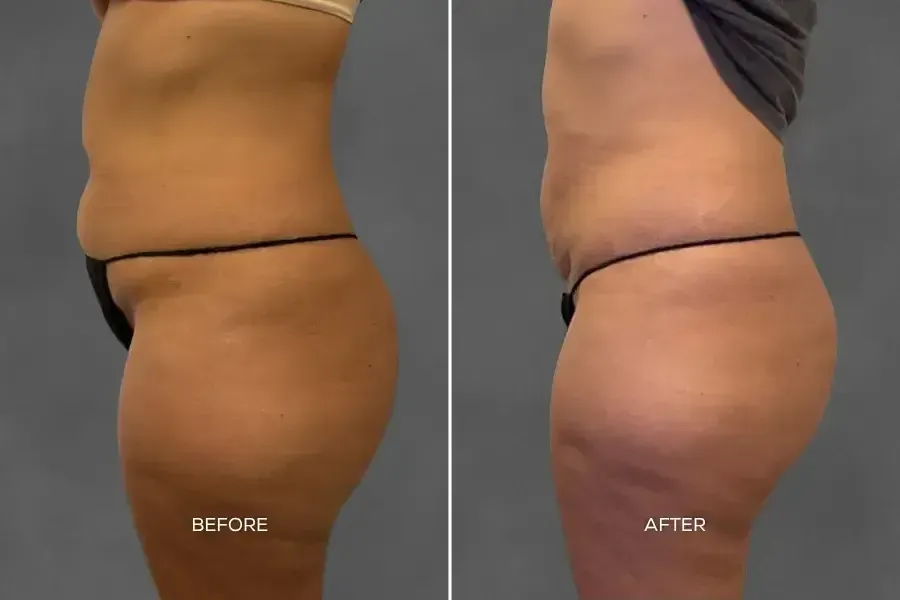 Side-by-side before and after photos showing improved body contouring and skin tightening on the abdomen and thighs following BodyTite treatment.