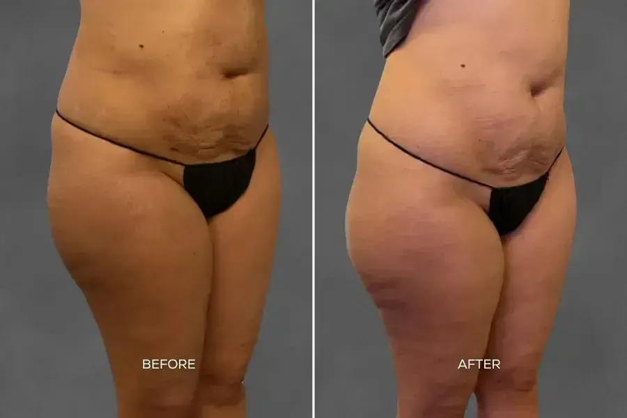 Side-by-side before and after photos showing visible improvement in abdominal contour, reduced cellulite, and smoother skin texture following Cellutone treatment.