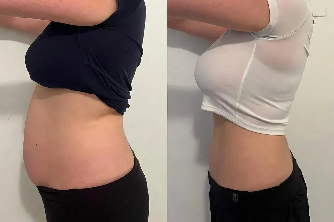 Before and after photos showing Physiq body contouring results with improved abdominal and flank definition and a more toned midsection at Chrome Aesthetics.