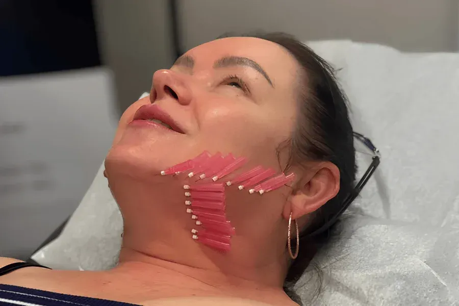 Woman undergoing a PDO Thread Lift with mono threads placed along the jawline and cheek for lifting and skin tightening at Chrome Aesthetics.