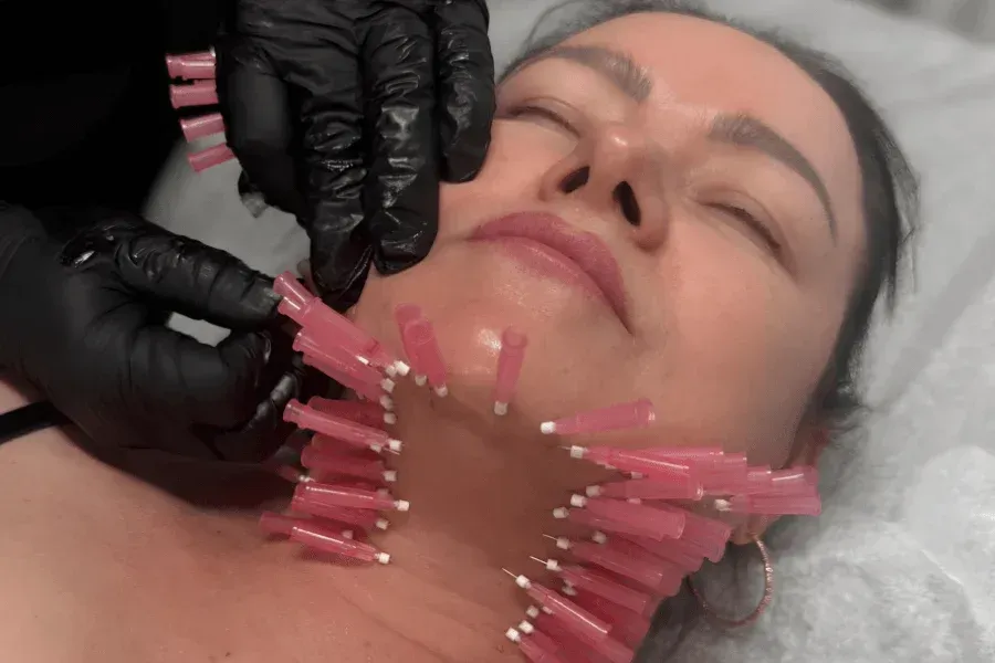 Woman undergoing a PDO Thread Lift with multiple pink threads placed along the jawline and neck for lifting and skin tightening at Chrome Aesthetics.