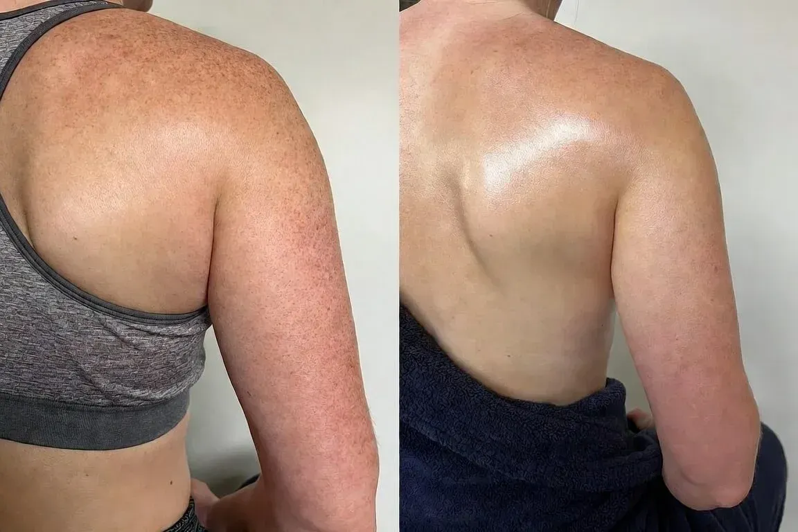 Before and after photos showing improved skin texture, reduced redness, and smoother appearance on the upper back and shoulders after DiamondGlow Body treatment at Chrome Aesthetics.