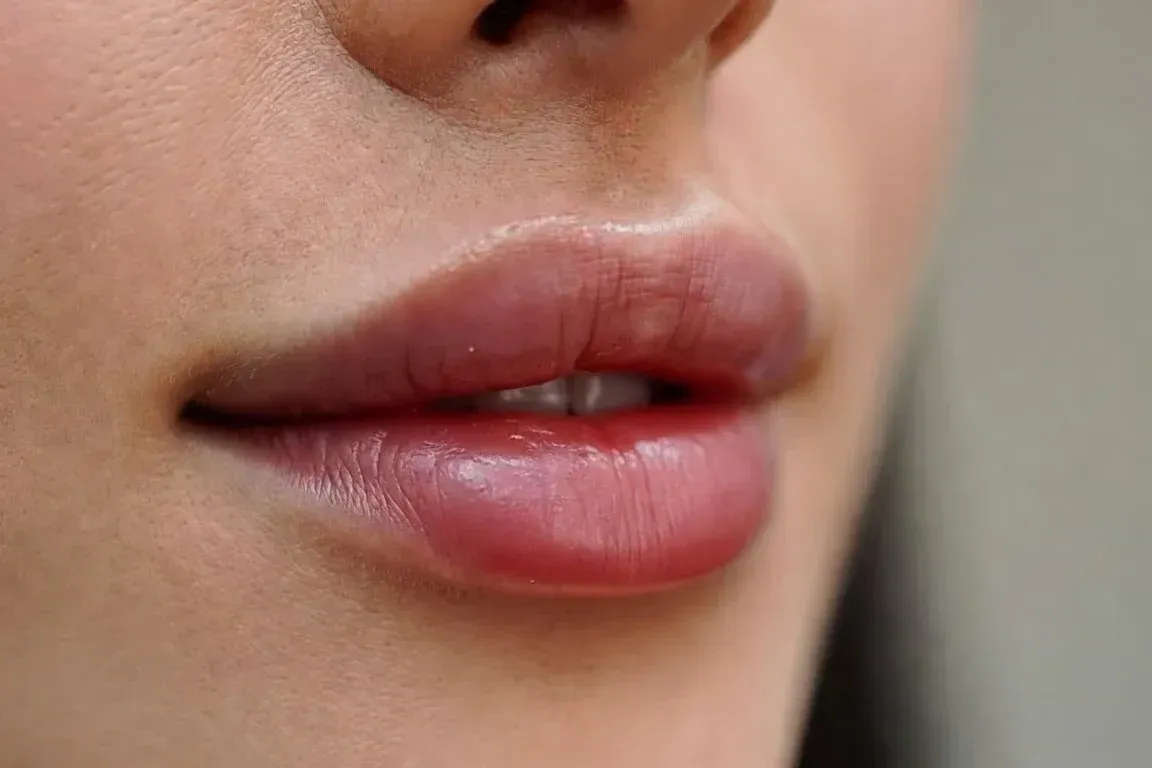 Close-up of naturally enhanced lips after a Lip Flip treatment using neuromodulator for a subtle lift and definition at Chrome Aesthetics.