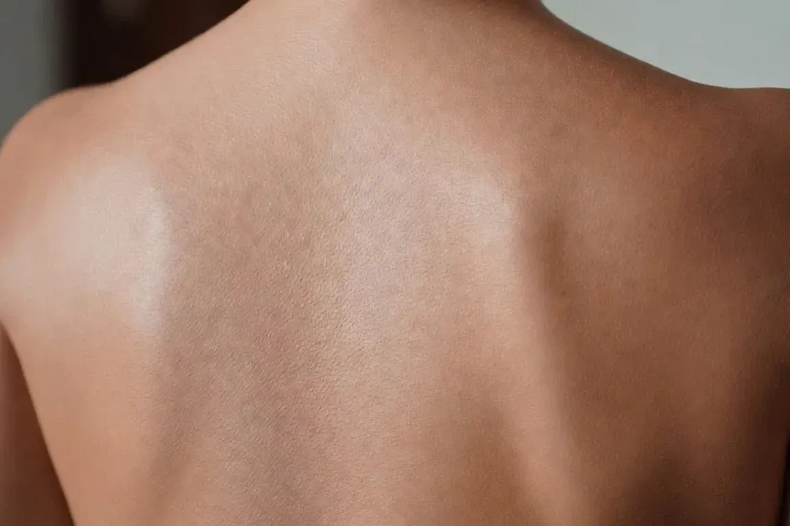 Smooth, even-toned back skin after BBL BroadBand Light photofacial treatment at Chrome Aesthetics Spa