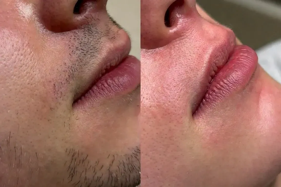 Before and after Forever Bare BBL laser hair removal on upper lip and chin at Chrome Aesthetics Spa
