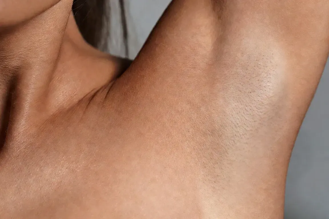 Smooth underarm skin after 6 Forever Bare BBL laser hair removal treatments at Chrome Aesthetics Spa