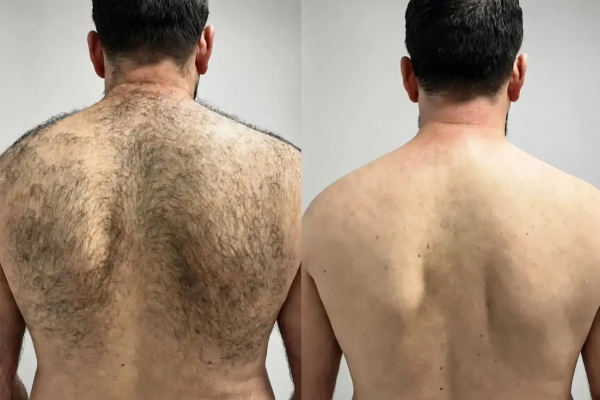Before and after 10 Forever Bare BBL laser hair removal treatments on man's back at Chrome Aesthetics Spa