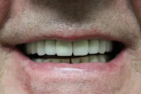 Teeth Gallery 7