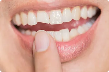 Chipped Tooth