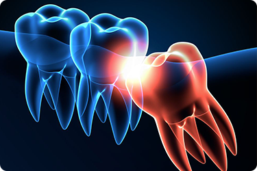 Wisdom Teeth