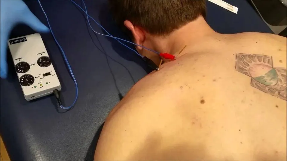 Electric Dry Needling at Evergreen Medical Acupuncture