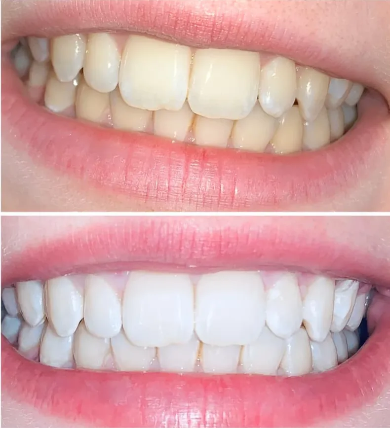 teeth-whitening-plymouth