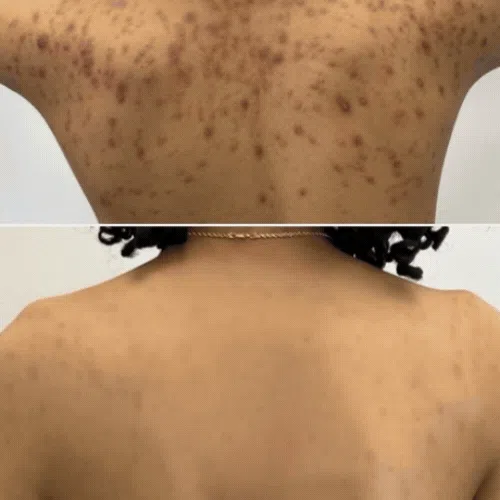 A Caucasian woman receiving a microdermabrasion facial treatment at Body in Balance, enhancing skin texture and glow with exfoliation.