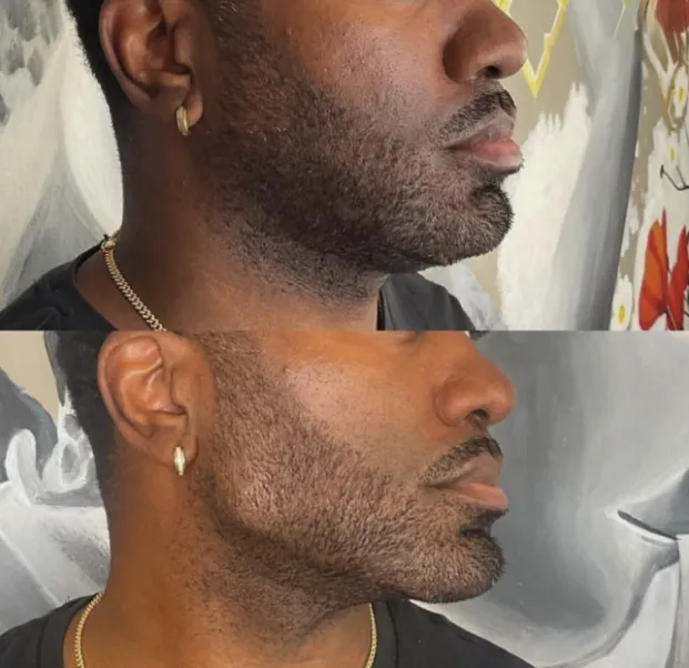 The Art of the Jawline: How Fillers are Sculpting Delray's Most Defined Looks