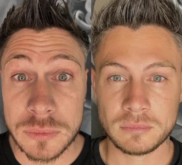 Man with botox treatment on his face.