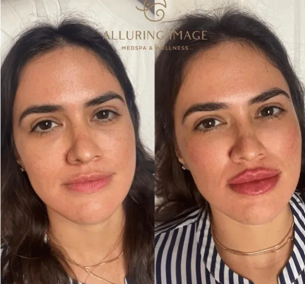 Beyond the Face: Surprising Ways Fillers Can Refresh Your Hands and Neck