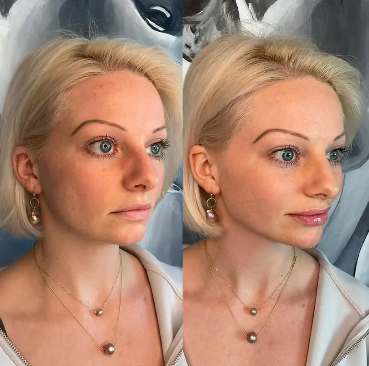 Close up of a medical professional preparing a syringe with advanced aesthetic product in a clinical laboratory setting.