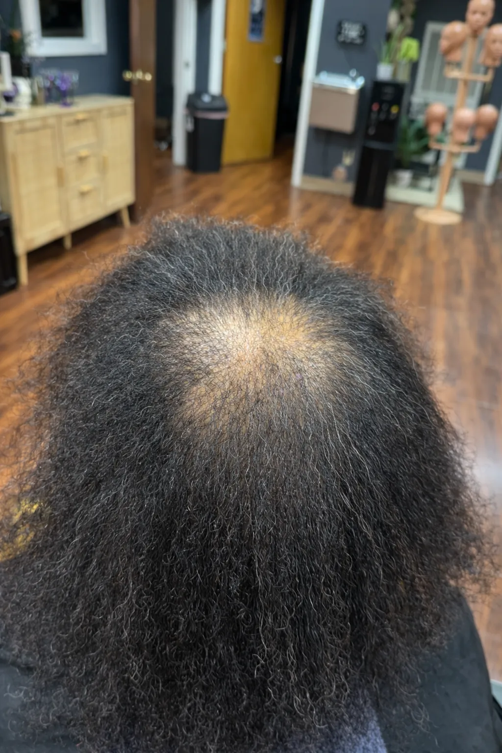 Before scalp therapy with visible thinning at the part