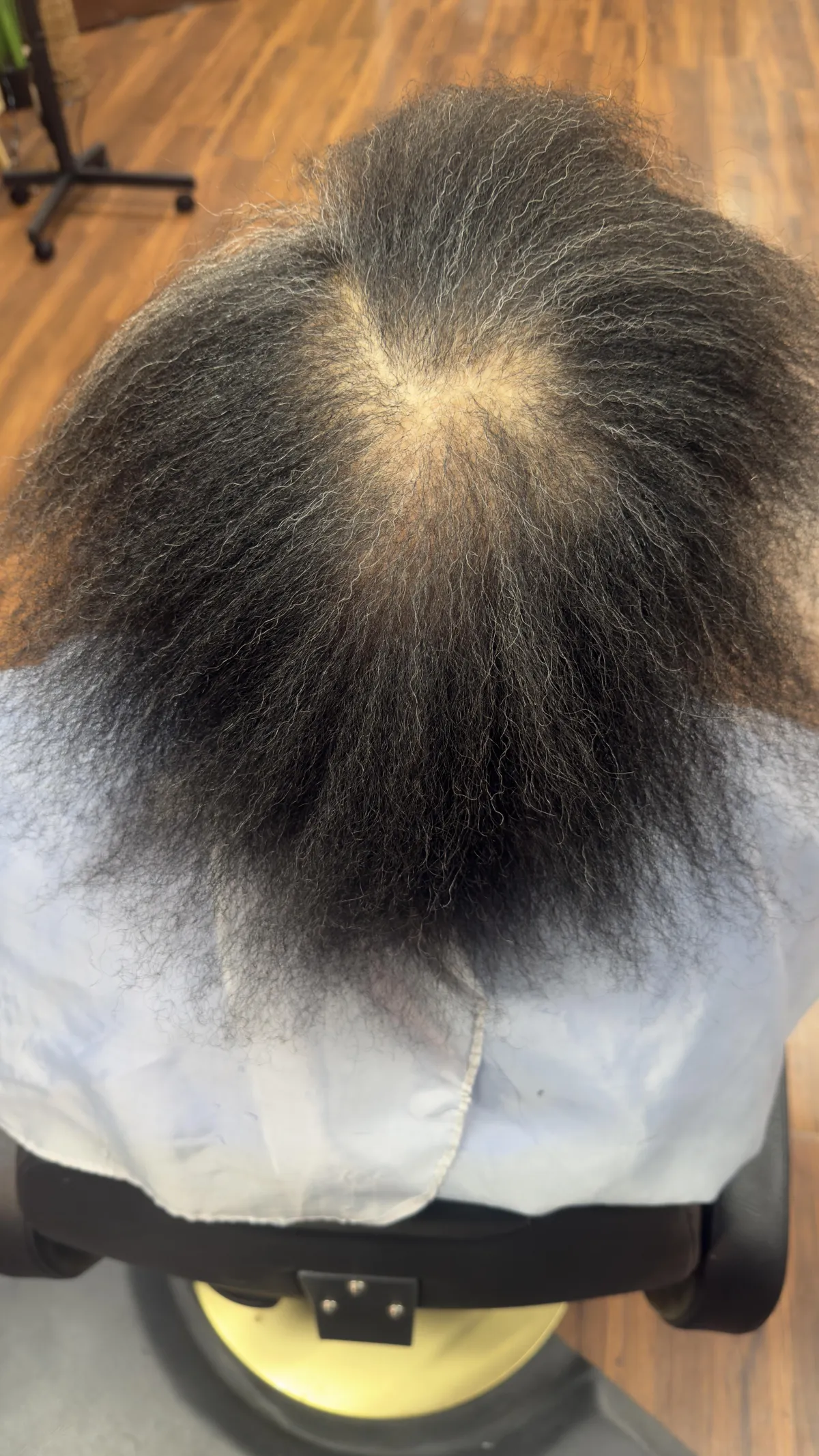 After scalp therapy showing fuller part and improved density