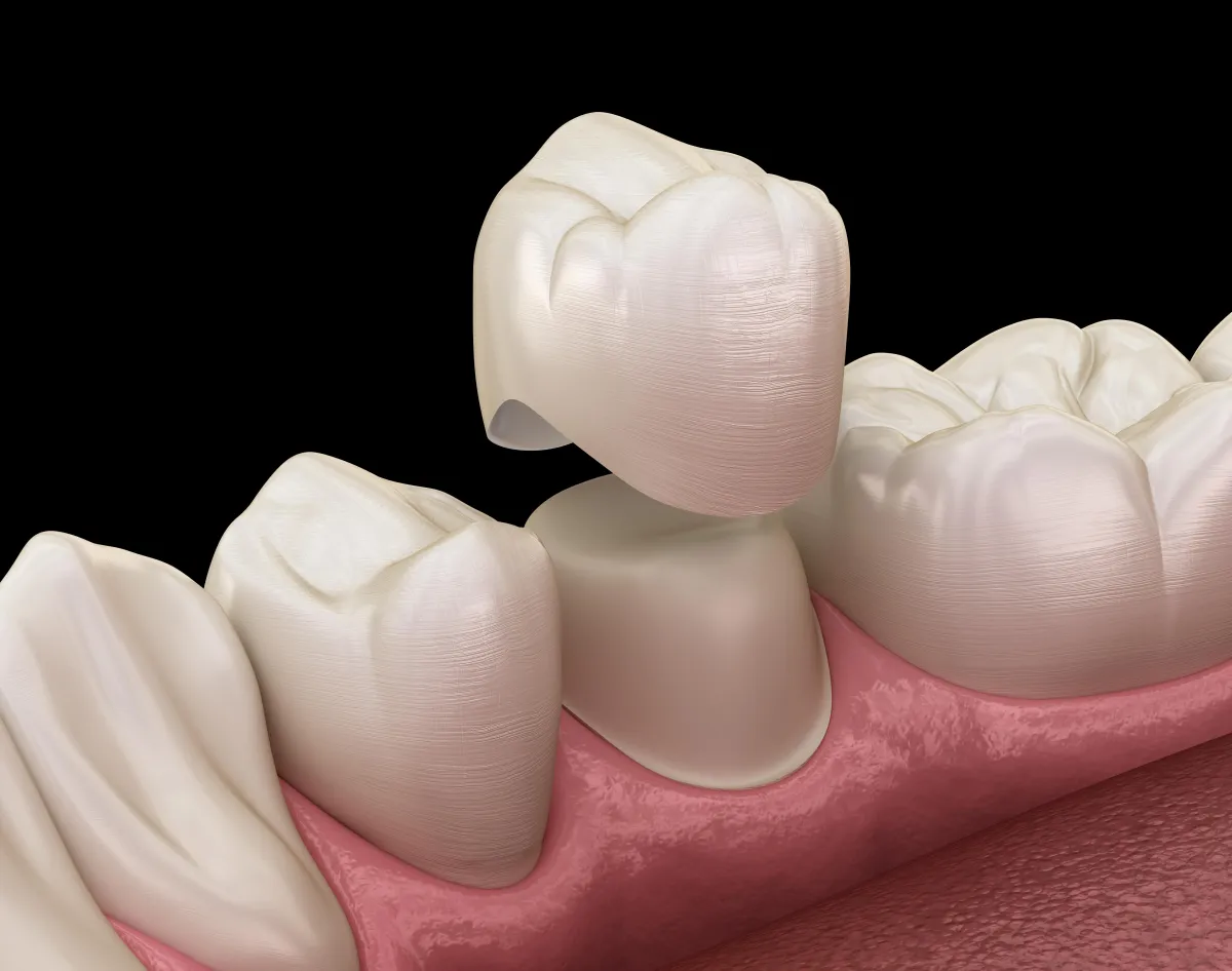 person with silver teeth braces