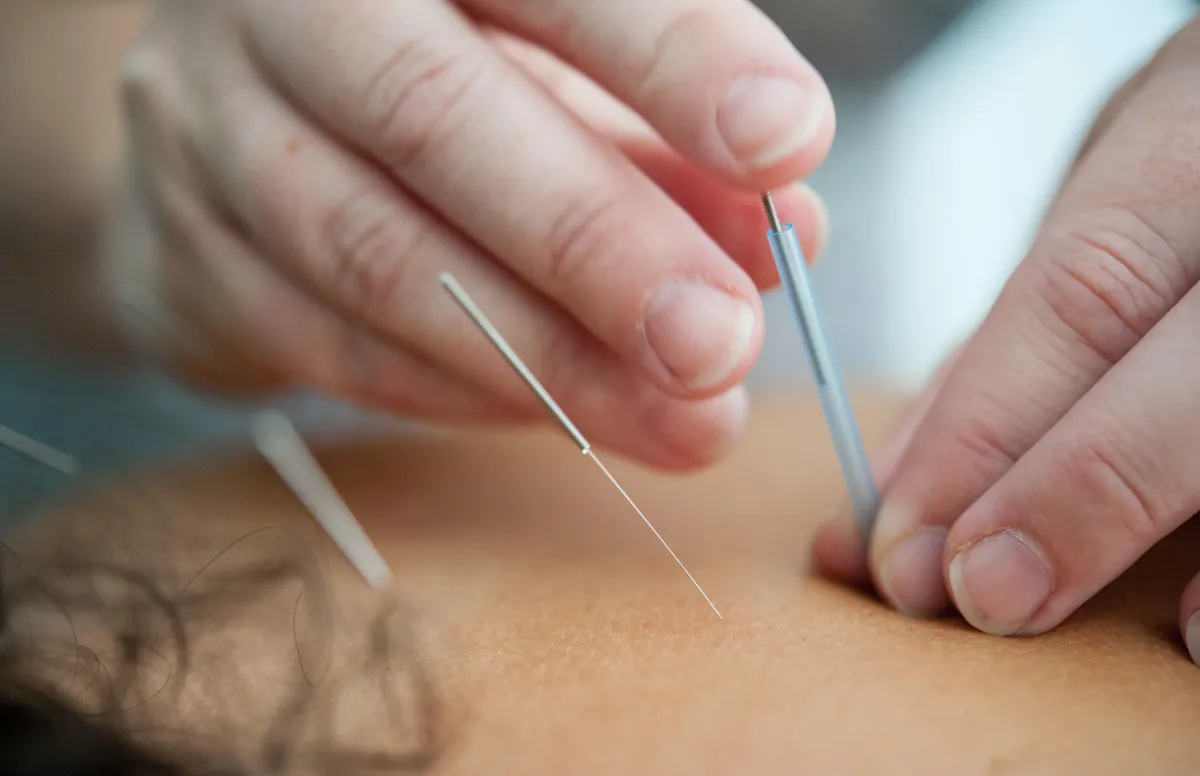 Acupuncture Needle Image