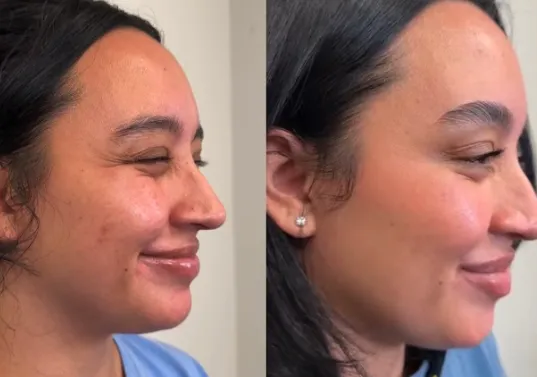 Hydrafacial Back