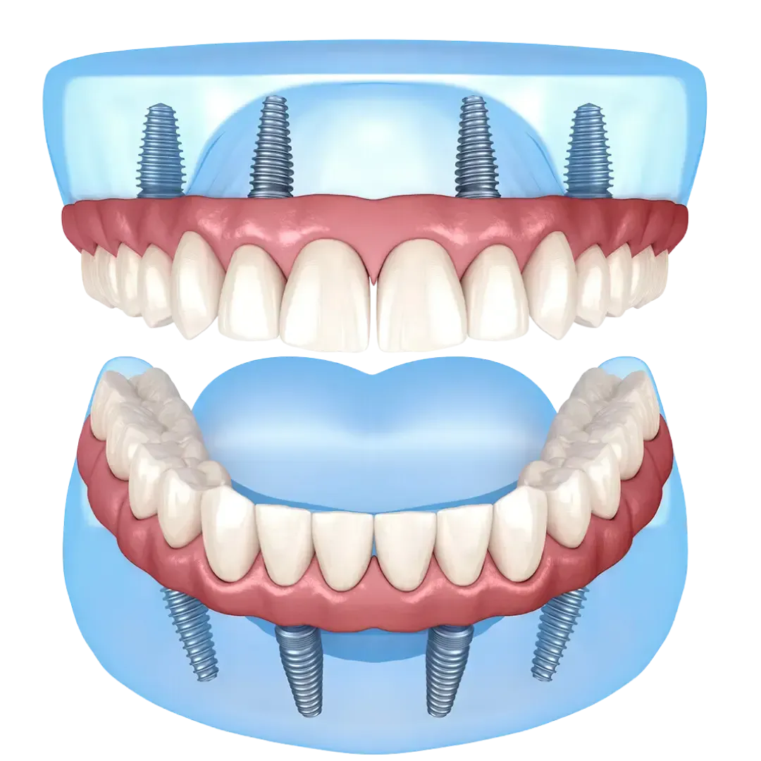 All on Four Dental Implants