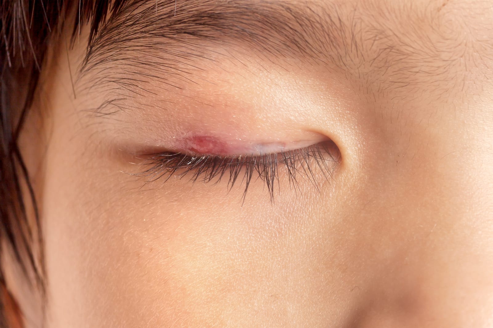 Stye vs Chalazion: Eyelid Bump Guide | St. George Eye Center